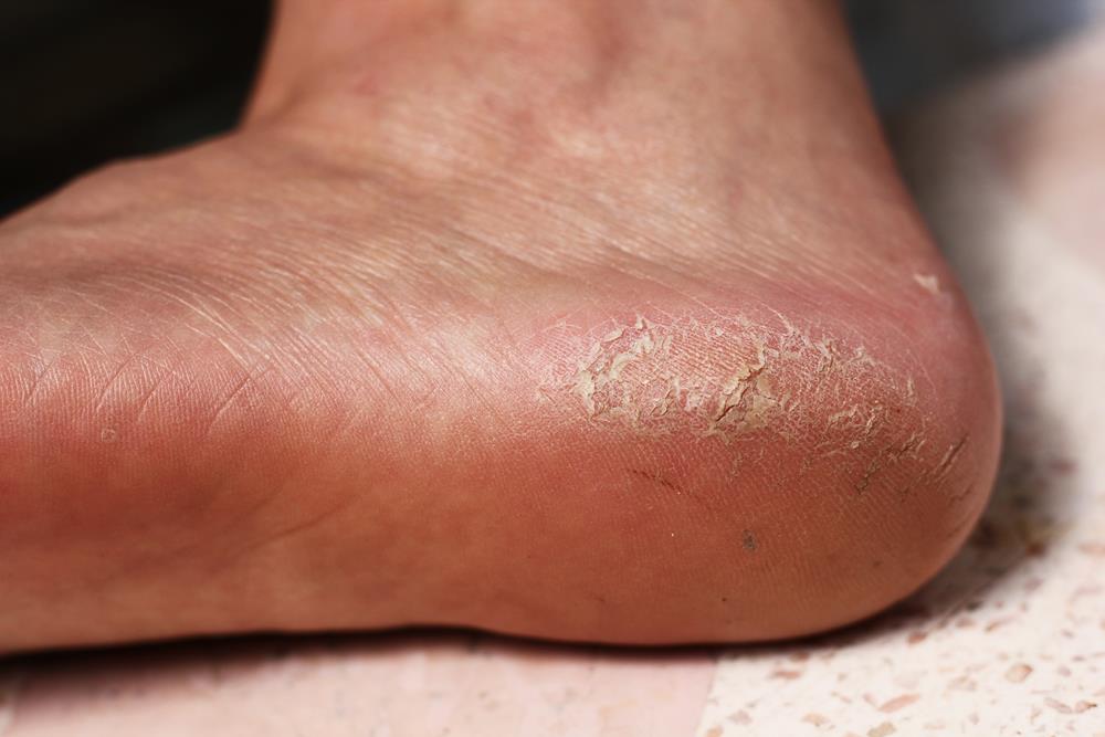 Calluses Upper Marlboro, MD,